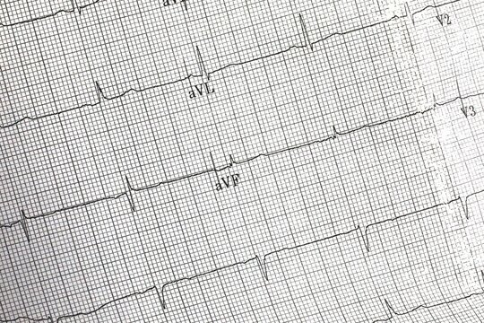 EKG test results from a patient with heart failure 