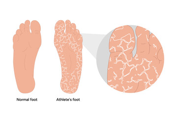 Normal and Athlete's foot - obrazy, fototapety, plakaty