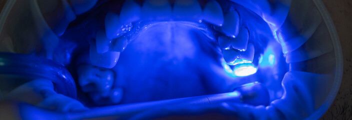 The dentist treats the patient's teeth, photo of the open mouth of the patient who came to the dental clinic, medical concept