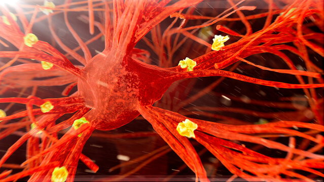 Amyloid plaques on nerve cells, illustration