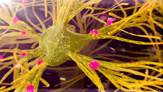 Amyloid plaques on nerve cells, illustration