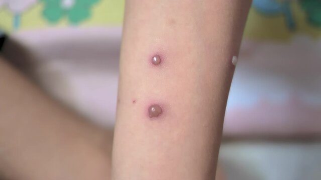 Chickenpox similar monkey pox bubbles on the hands of a young southeast Asian child videotaped up close and handheld 4K