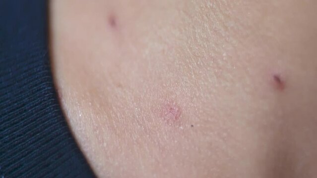 Examining Monkeypox-Like Blisters on Kid&rsquo;s Skin: Detailed Close-Up 4K. Monkey pox like blister on the neck of a small southeast Asian child that has dried up.