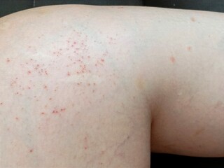 Itchy rash on the skin of the legs
