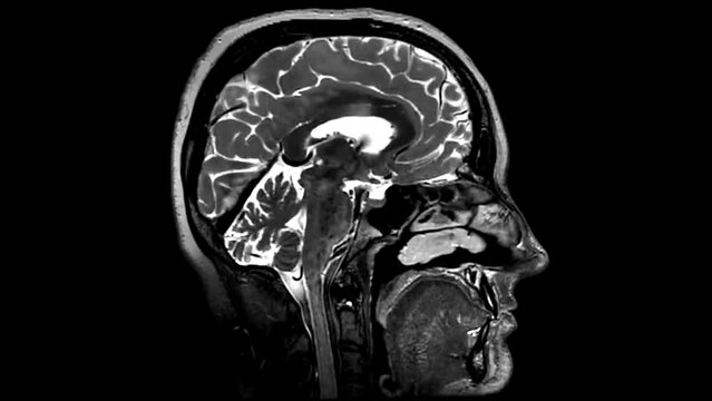 MRI brain scans sagittal view offer functioning and pathology for medical assessments.
