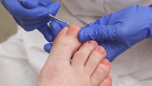 A professional podologist cleans the skin under the big toe nail of a female client with a special tool. Foot care