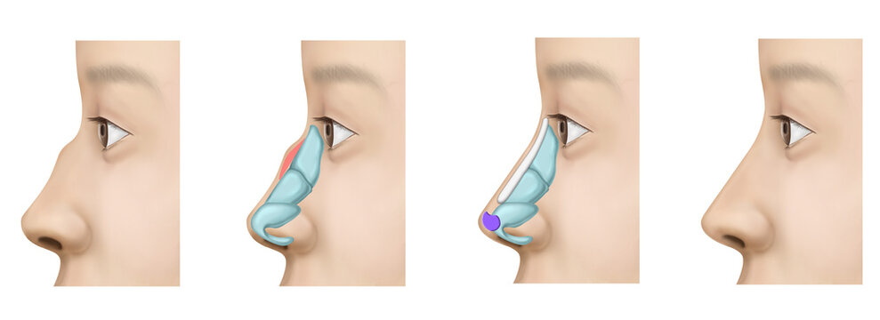 hooked nose surgery