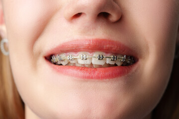 Young woman with dental braces close up - 788461579