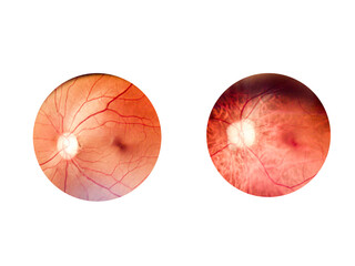 Patient elderly with retina of diabetes.Human eye anatomy taking images with Mydriatic Retinal...