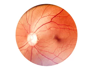 Patient elderly with retina of diabetes.Human eye anatomy taking images with Mydriatic Retinal cameras. © Mohwet