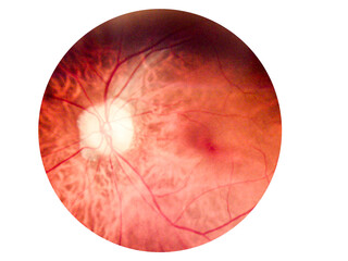 Patient elderly with retina of diabetes.Human eye anatomy taking images with Mydriatic Retinal...