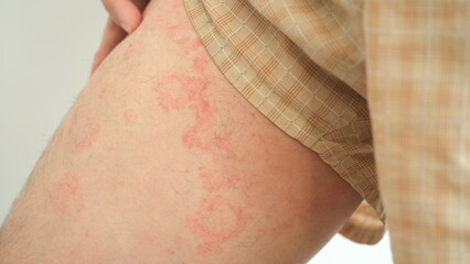 Close up image of skin texture suffering severe urticaria or hives or kaligata on a man's thighs....