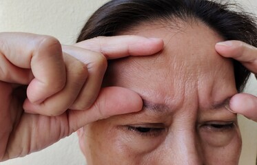 close up of a person holding the flabbiness and wrinkle, forehead lines and headache, stress and...