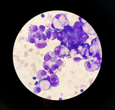 Malignant fluid cytology; Cells of adenocarcinoma may spread to fluid of pleural or peritoneal cavity in cancer from the breast, lung, colon, pancreas, ovary, endometrium or other sites.