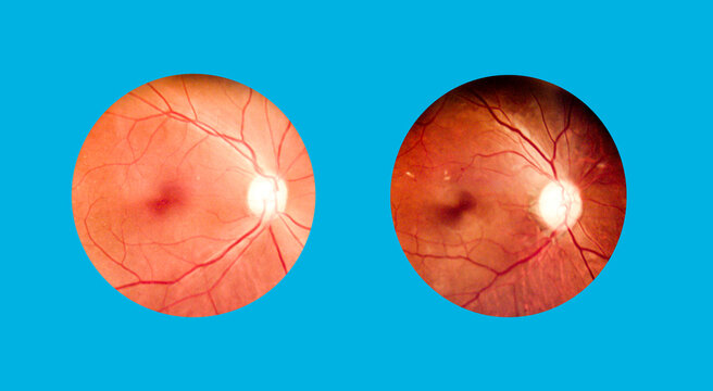 Patient elderly with retina of diabetes.Human eye anatomy taking images with Mydriatic Retinal cameras.A prepapillary vascular loop on the retina, as observed during ophthalmoscopy.