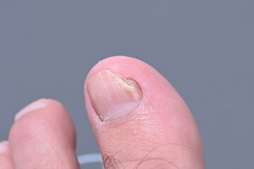 mycosis Fungal infection of the big toe nails. Fungal infection of toenails with ringworm...