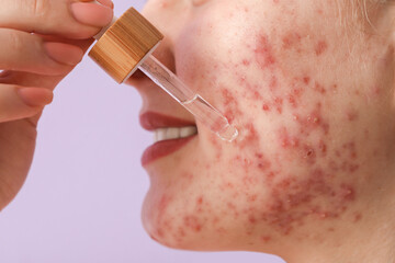 Young woman with acne problem applying serum on lilac background, closeup