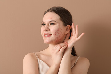 Young woman with acne problem on brown background, closeup