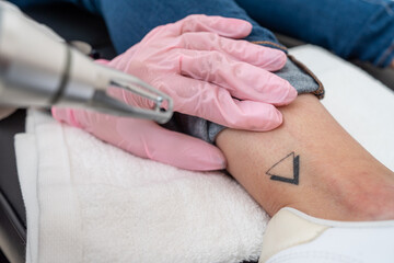 close up of Cosmetic tattoo removal treatment by professional: laser procedure for ink removal