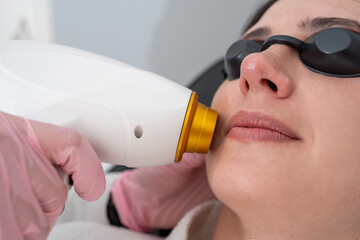 Close up of facial hair laser epilation and removal for woman at dermatology clinic