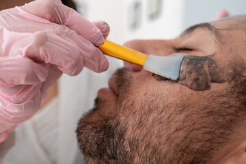 close up of a Young man receiving Hollywood peel facial treatment by doctor: skincare and peeling...