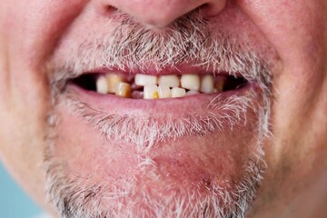 Missed Smile: Broken Teeth