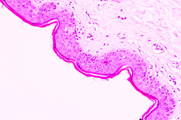 Backgrounds of human cells tissue of cervix under the microscope in pathology lab.View in microscopic of ductal cell carcinoma, adenonocarcinoma from human breast cancer, tissue section by H and E