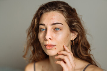 Pimples and acne on the woman's face.  Medicine and cosmetology concept. Natural skin.