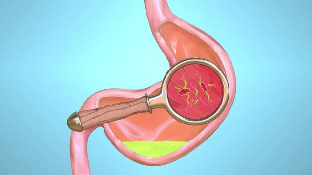 Science animation about the Helicobacter pylori bacteria in the stomach