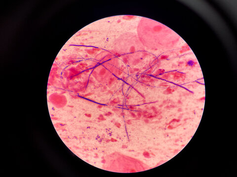 Mold yeast cell in sputum gram stain.