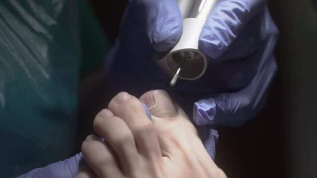 Podologist polishes the toe cuticle toe fingers with a mechanical device 