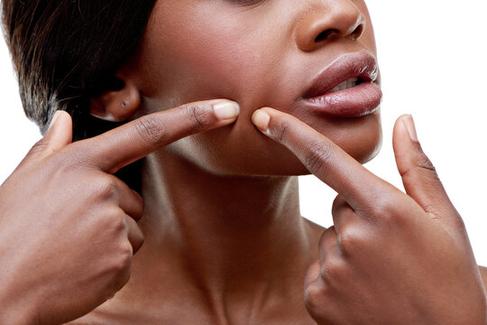 Acne, skincare and woman squeeze pimple closeup in white background of studio with hygiene risk of self care. Dermatology, cosmetics and hands on face to pop blackhead, zit or spot with fingers