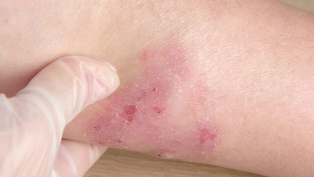 doctor examines itchy skin on legs, inflammation and Medical Allergies, disease on body of female patient, Dermatology Skin Issues, health care, skin problems, health care, human tissue regeneration