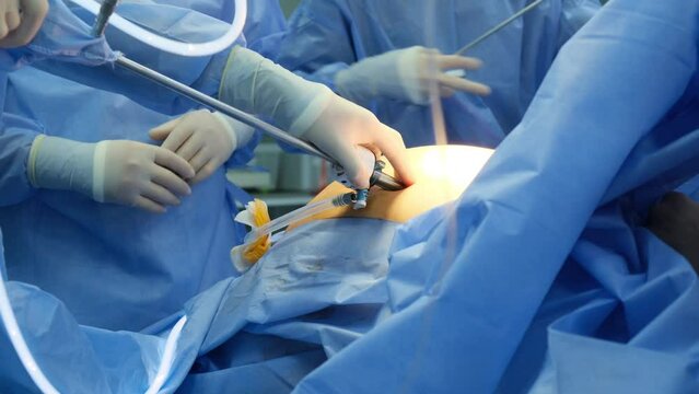 Laparoscopic cholecystectomy instrument. The surgeon's doing laparoscopic gastric sleeve surgery in the operating room. Selective Focus.