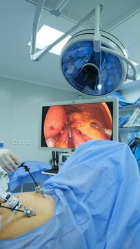 Laparoscopic surgery. The patient's internal organs are being sutured on the monitor screen. Vertical video.