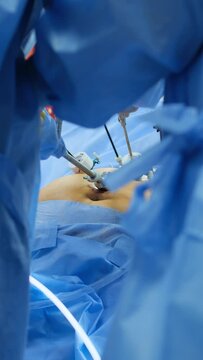 The surgeon's doing laparoscopic gastric sleeve surgery in the operating room. Vertical video