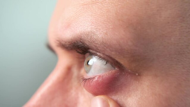 Close-up of a person with a swollen lower eyelid, indicating a chalazion or barley on the eye. Medical and health concept for educational material and diagnostics