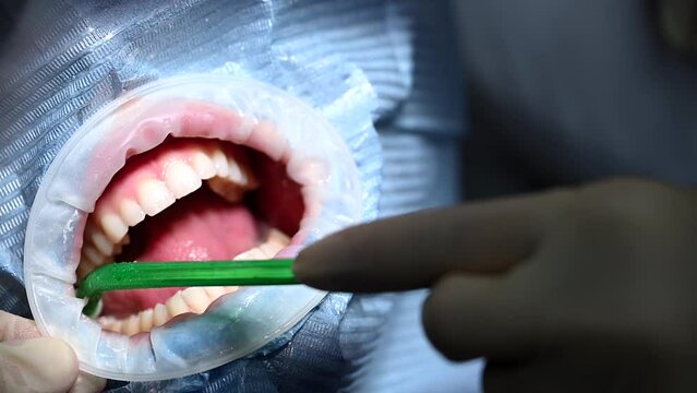 Detailed close view of a persons mouth and teeth, showcasing dental health and hygiene.