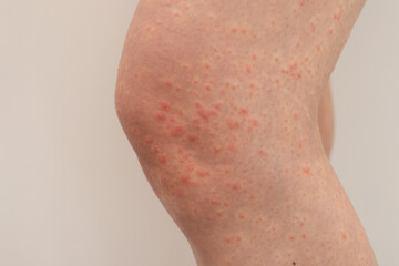 Urticaria allergy on woman legs