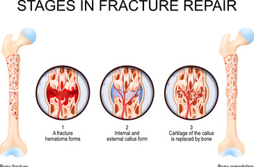 Stages in fracture repair. From Bone fracture to Bone remodeling