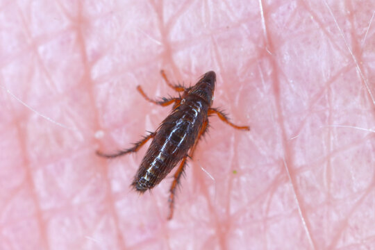 The flea feeds on human skin. Painful flea bite.