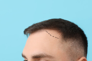 Fototapeta premium Young man with hair loss problem and marks on his forehead against blue background, closeup