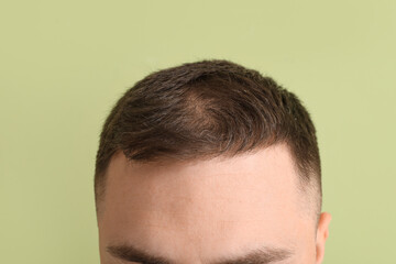 Fototapeta premium Young man with hair loss problem on green background, closeup