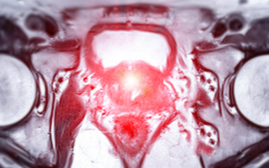 MRI of the prostate gland reveals Focal abnormal SI lesion at left PZpl at apex as described; PI-RADS category 4, clinically