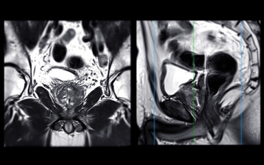 MRI of the prostate gland reveals Focal abnormal SI lesion at left PZpl at apex as described;...