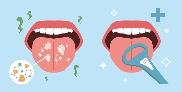 Bad smell removal. Cleaning tongue, halitosis prevention, oral hygiene, plaque removal process, fighting bad breath, bacteria, health care cartoon flat isolated nowaday vector concept