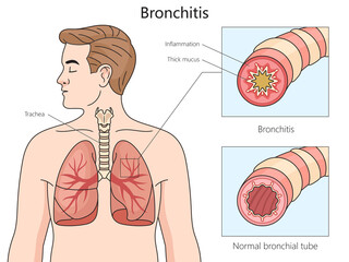 Healthy and bronchitis affected bronchial tubes, with a focus on inflammation and mucus buildup structure diagram hand drawn schematic raster illustration. Medical science educational illustration - 791556944