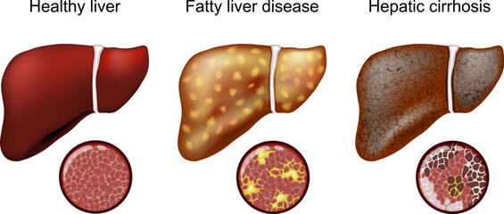 Fatty liver disease. Hepatic cirrhosis