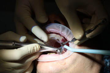 Installation of a dental implant. A real operation. Close-up. An open mouth. Dentistry and the...
