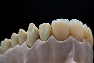 Zähne, Gebiss, Zahntechnik. Zahnersatz